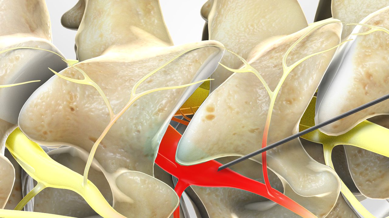 Nerve Root Block Treatment in Bangalore