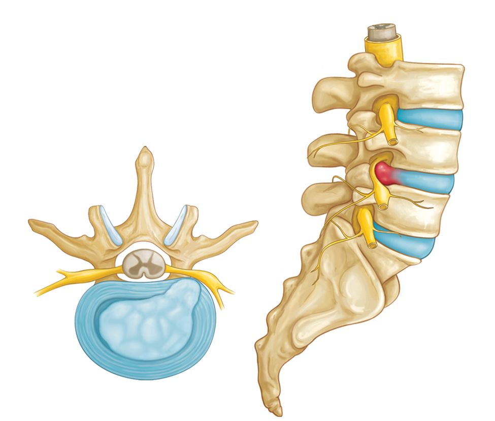 herniated disc